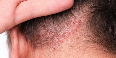 Scalp Psoriasis
